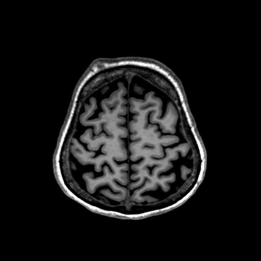 Autoimmune limbic encephalitis (Radiopaedia 30363-31005 T1 Axial 1mm 124).jpg