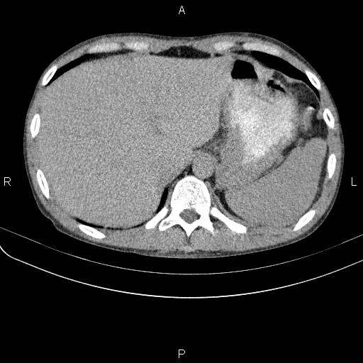 File:Autoimmune pancreatitis (Radiopaedia 84925-100431 Axial C+ delayed 7).jpg