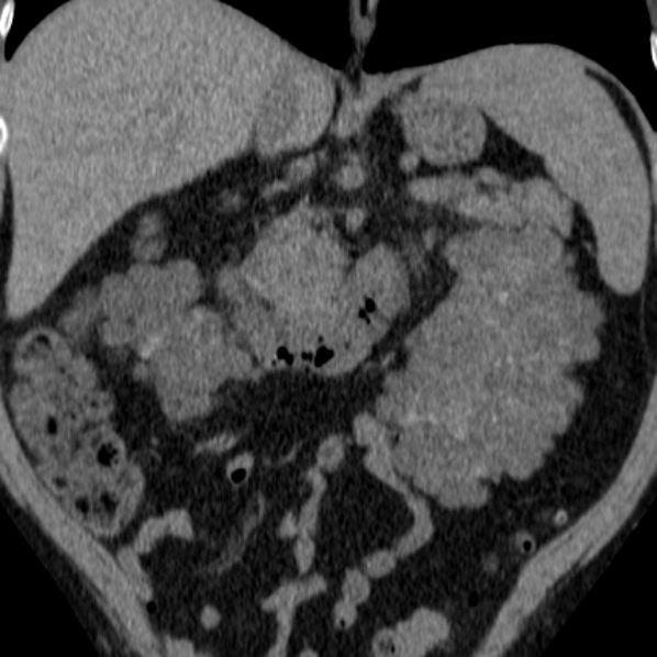 File:Autosomal dominant polycystic kidney disease (Radiopaedia 36539-38101 Coronal non-contrast 17).jpg