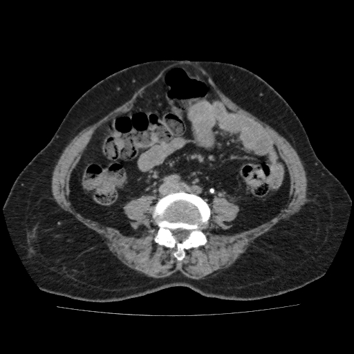 File:Autosomal dominant polycystic kidney disease (Radiopaedia 38189-40194 Axial C+ delayed 35).jpg