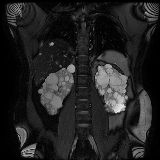 File:Autosomal dominant polycystic kidney disease (Radiopaedia 50259-55611 Coronal FIESTA 23).jpg
