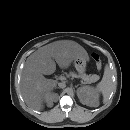 Autosomal dominant polycystic kidney disease (Radiopaedia 50259-55612 Axial non-contrast 28).jpg