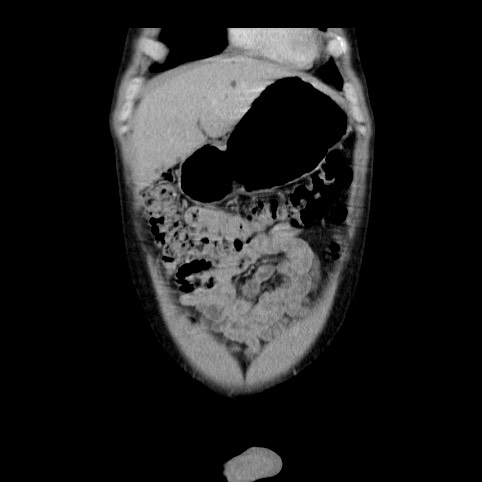 Autosomal dominant polycystic kidney disease (Radiopaedia 66349-75582 A 3).jpg