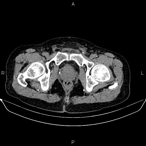 File:Autosomal dominant polycystic kidney disease (Radiopaedia 87830-104287 Axial non-contrast 55).jpg