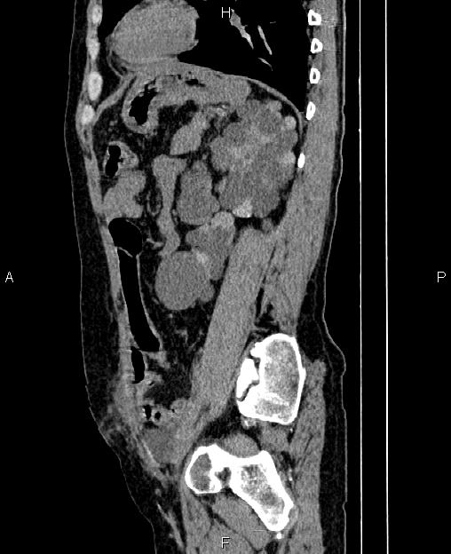 Autosomal dominant polycystic kidney disease (Radiopaedia 87830-104287 C 63).jpg