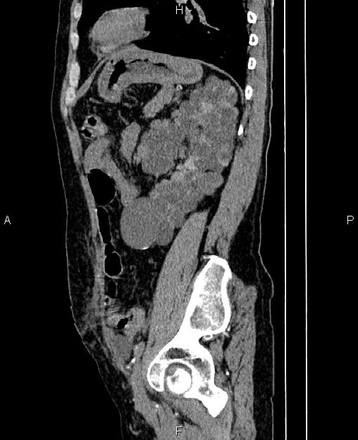 Autosomal dominant polycystic kidney disease (Radiopaedia 87830-104287 C 66).jpg