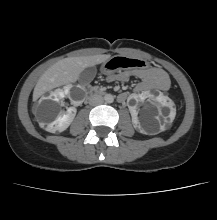 Autosomal dominant polycystic kidney disease - early onset (Radiopaedia 40734-43387 A 42).jpg