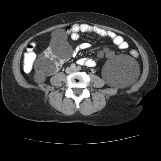 Autosomal dominant polycystic kidney disease with hepatic involvement (Radiopaedia 32693-33662 C 51).jpg