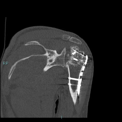 Avascular necrosis after fracture dislocations of the proximal humerus (Radiopaedia 88078-104655 Coronal bone window 72).jpg