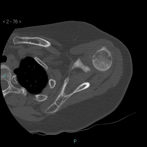 File:Avascular necrosis of the shoulder - Cruess stage I (Radiopaedia 77674-89887 Axial bone window 19).jpg