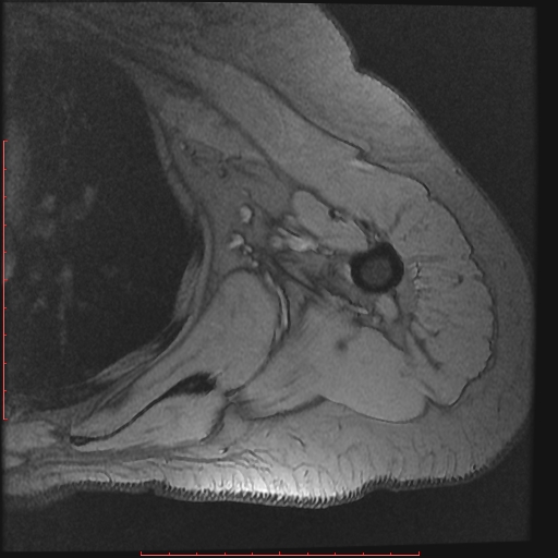 File:Avulsion fracture - greater tuberosity of humerus (Radiopaedia 25457-25703 Axial Gradient Echo 19).jpg