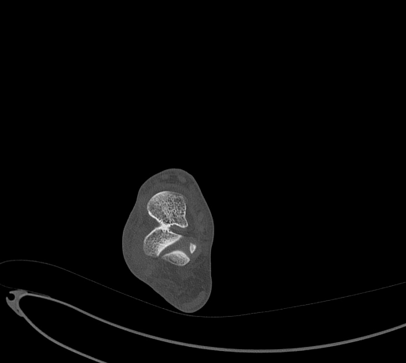 Avulsion fractures of talus and calcaneus (Radiopaedia 48277-53155 Axial bone window 35).jpg