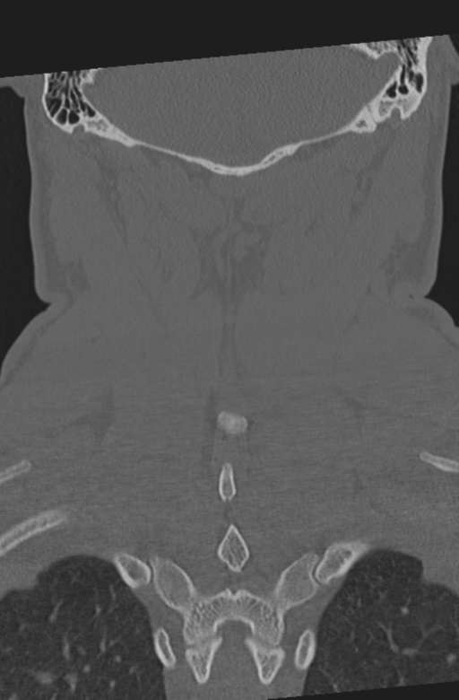 Axis peg fracture (type 3) and atlas lateral mass (type 4) fracture (Radiopaedia 37474-39324 Coronal bone window 48).png