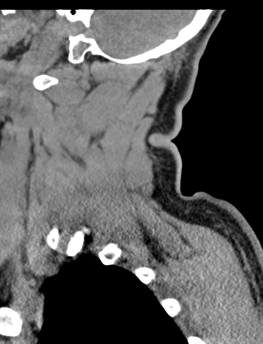 Axis peg fracture (type 3) and atlas lateral mass (type 4) fracture (Radiopaedia 37474-39324 D 14).png