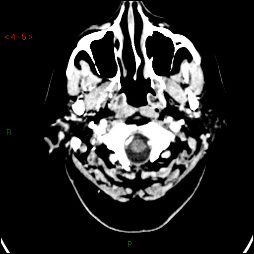 Azygos anterior cerebral artery (Radiopaedia 51987-57833 A 5).jpg