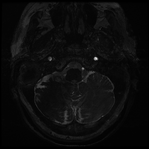 Balo concentric sclerosis (Radiopaedia 53875-59982 Axial T2 FIESTA 4).jpg