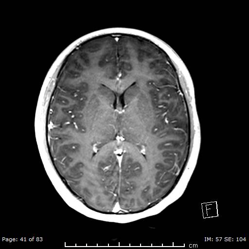 Balo concentric sclerosis (Radiopaedia 61637-69636 Axial T1 C+ 41).jpg