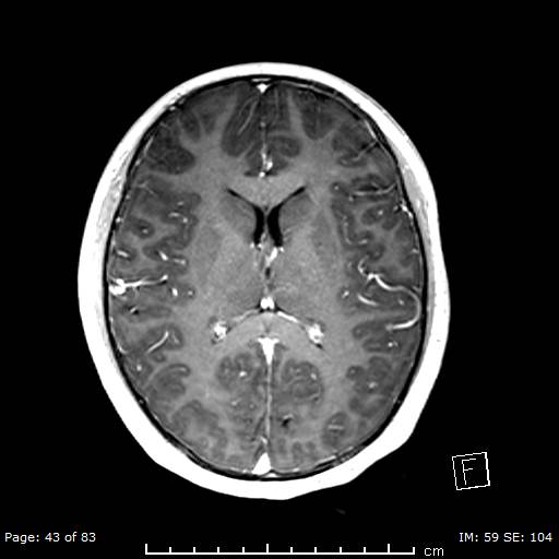 Balo concentric sclerosis (Radiopaedia 61637-69636 Axial T1 C+ 43).jpg