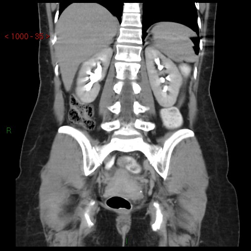 File:Bartholin gland cyst (Radiopaedia 54904-61181 Coronal C+ delayed 35).jpg