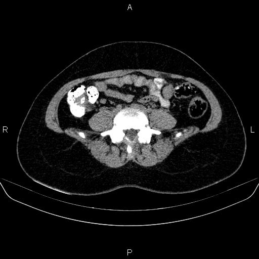 File:Bartholin gland cyst (Radiopaedia 62635-70930 Axial non-contrast 1).jpg