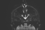 File:Basal cell carcinoma - nasal region (Radiopaedia 70292-80365 Axial DWI 30).jpg