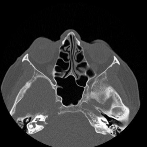 File:Base of skull chondrosarcoma (Radiopaedia 30410-31071 Axial bone window 23).jpg