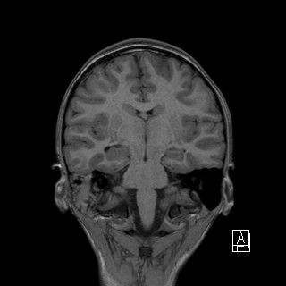 Base of skull rhabdomyosarcoma (Radiopaedia 32196-33142 Coronal T1 26).jpg