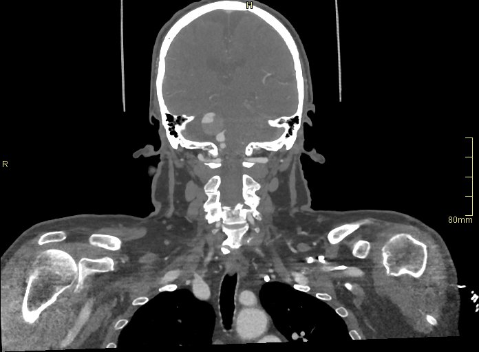Basilar artery aneurysm (Radiopaedia 56261-62932 B 37).jpg