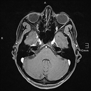 Basilar artery perforator aneurysm (Radiopaedia 82455-99523 G 30).jpg