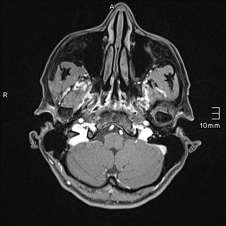 Basilar artery perforator aneurysm (Radiopaedia 82455-99523 G 9).jpg