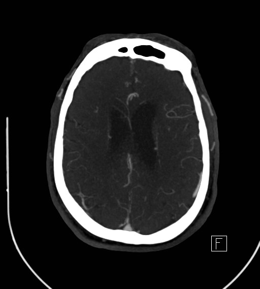Basilar artery thrombosis (Radiopaedia 26986-27163 A 59).jpg