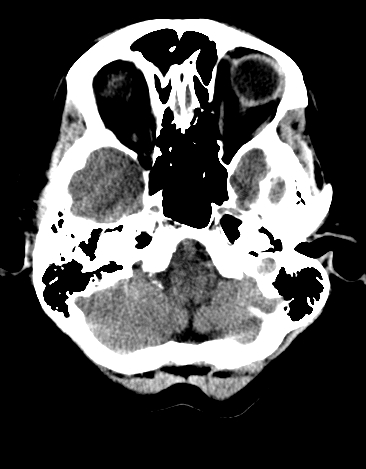 File:Basilar tip aneurysm with coiling (Radiopaedia 53912-60033 Axial 21).jpg