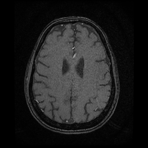 Basilar top and left middle cerebral artery aneurysm (Radiopaedia 61965-70031 Axial MRA 119).jpg