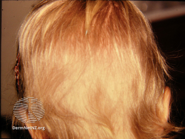 File:Beaded hair or monilethrix (DermNet NZ hair-nails-sweat-monilethrix1).jpg