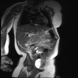 File:Beckwith-Wiedeman syndrome with bilateral Wilms tumors (Radiopaedia 60850-69233 B 16).jpg