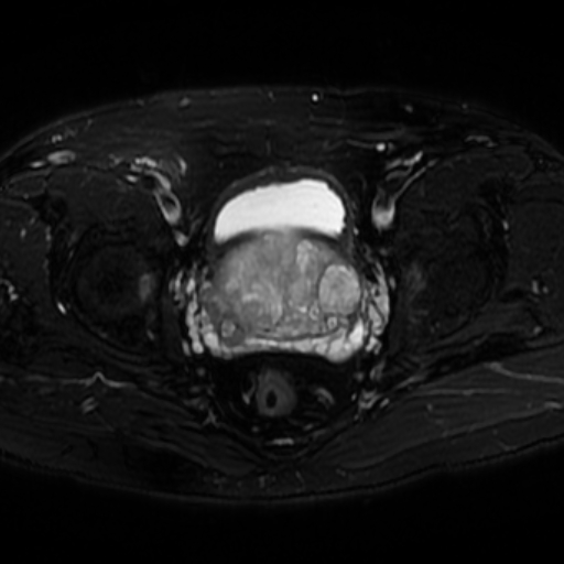 File:Benign prostatic nodular hyperplasia (Radiopaedia 16917-16634 Axial T2 fat sat 6).jpg