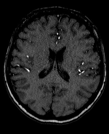 File:Berry aneurysm of the terminal internal carotid artery (Radiopaedia 88286-104918 Axial TOF 146).jpg