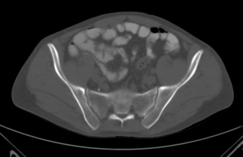 File:Bertolotti syndrome (Radiopaedia 58974-66235 Axial bone window 3).jpg