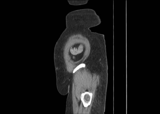 Bicameral celiacomesenteric aneurysm (Radiopaedia 55766-62327 B 54).jpg