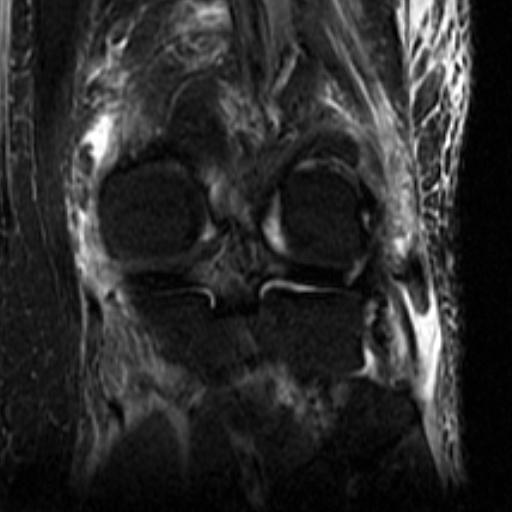 File:Biceps femoris distal tendon avulsion (Radiopaedia 15109-14987 Coronal STIR 7).jpg