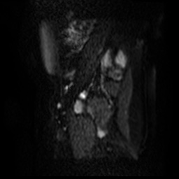 File:Bicornuate uterus (Radiopaedia 51676-57472 Sagittal DWI 22).jpg