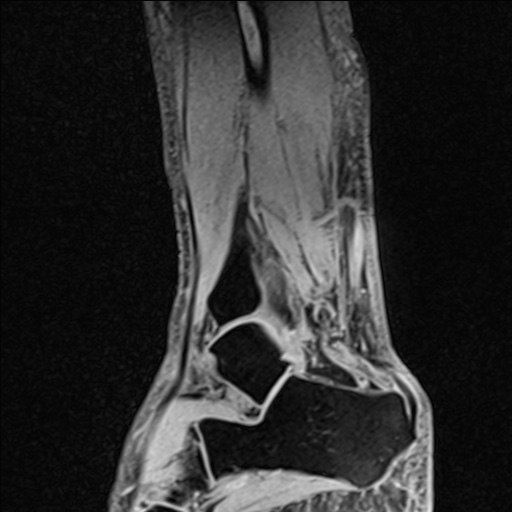 Bilateral Achilles tendon complete tear (Radiopaedia 81344-95051 Sagittal WE - Right 36).jpg