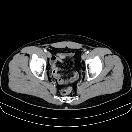 Bilateral accessory renal arteries with mild pelvi-ureteric junction (PUJ) obstruction (Radiopaedia 66357-75596 A 66).jpg
