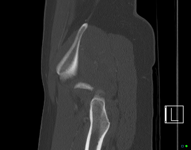 Bilateral acetabular fractures (Radiopaedia 79272-92308 Sagittal bone window 77).jpg