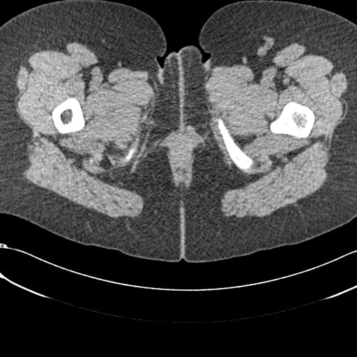Bilateral acetabular protrusion with pincer type femoro-acetabular impingement (Radiopaedia 30134-30733 AXIAL SOFT THIN 114).jpg