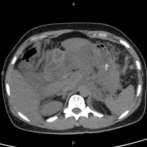 Bilateral adrenal gland hyperenhancement in pancreatitis (Radiopaedia 86642-102753 Axial non-contrast 29).jpg
