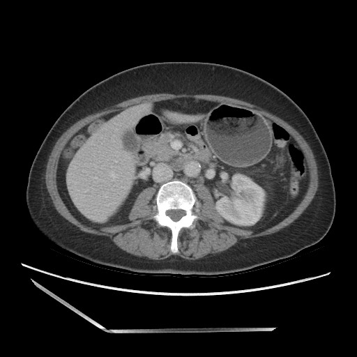 File:Bilateral adrenal granulocytic sarcomas (chloromas) (Radiopaedia 78375-91007 A 54).jpg