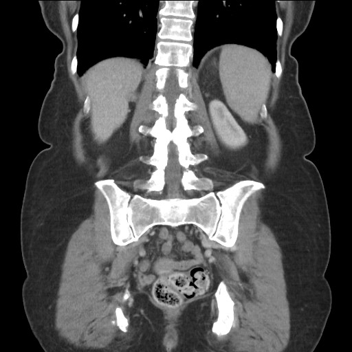 Bilateral adrenal granulocytic sarcomas (chloromas) (Radiopaedia 78375-91007 B 69).jpg