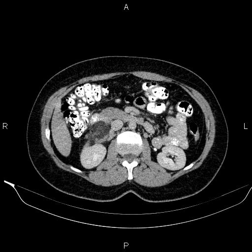 Bilateral adrenal myelolipoma (Radiopaedia 63058-71535 Axial C+ delayed 52).jpg