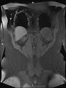 Bilateral adrenal myelolipoma (Radiopaedia 63058-71537 Coronal T1 fat sat 16).jpg